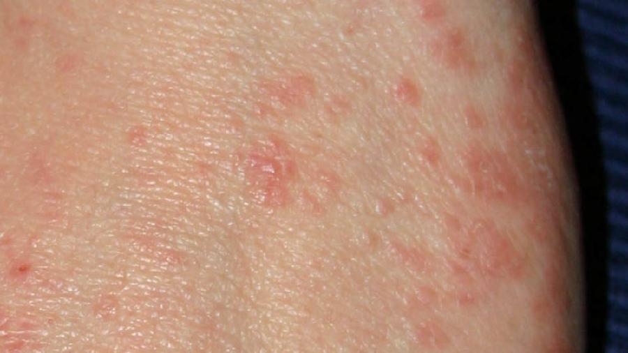 Šuge ima u većini opština, trećina zaraženih u vrtićima